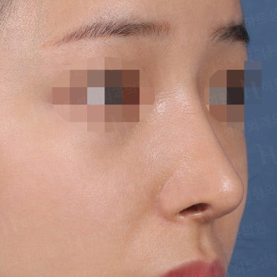코성형 재수술 후기 [히트성형외과 코성형] 사진 5