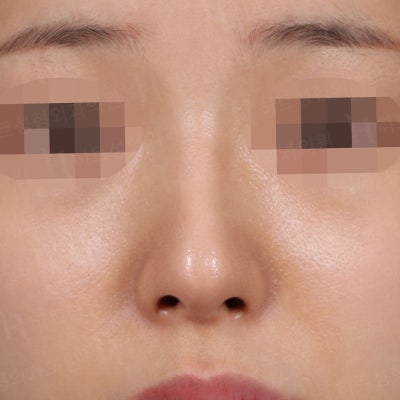 코성형 재수술 후기 [히트성형외과 코성형]