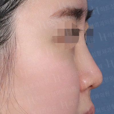 작고 낮은 코, 얼굴이 밋밋하다면? [히트성형외과 코성형] 사진 3