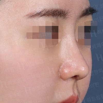 작고 낮은 코, 얼굴이 밋밋하다면? [히트성형외과 코성형] 사진 5