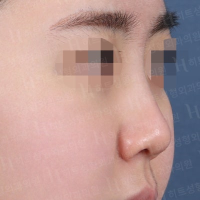 작고 낮은 코, 얼굴이 밋밋하다면? [히트성형외과 코성형] 사진 2