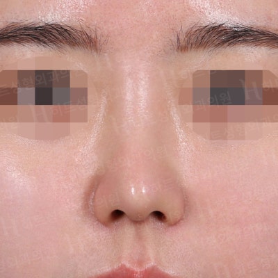 작고 낮은 코, 얼굴이 밋밋하다면? [히트성형외과 코성형] 사진 4