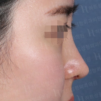 작고 낮은 코, 얼굴이 밋밋하다면? [히트성형외과 코성형] 사진 6