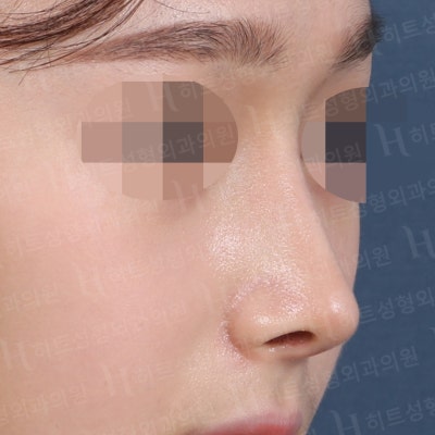 메부리코+복코 완벽개선 [히트성형외과 코성형] 사진 5