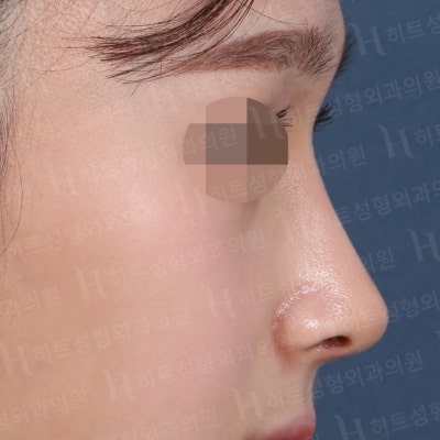 메부리코+복코 완벽개선 [히트성형외과 코성형] 사진 6