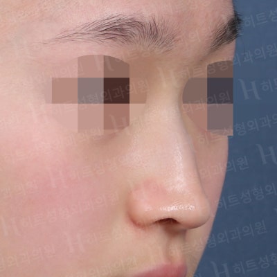 메부리코+복코 완벽개선 [히트성형외과 코성형] 사진 2