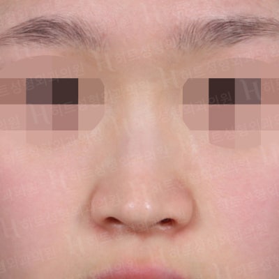 메부리코+복코 완벽개선 [히트성형외과 코성형]