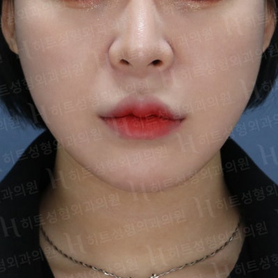 다이어트를 해도 안 빠지는 얼굴살? [히트성형외과] 사진 4