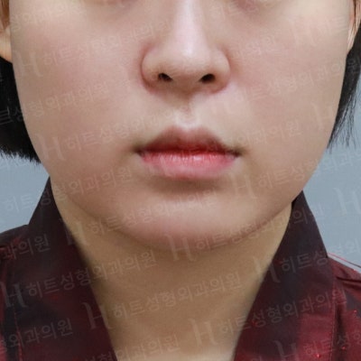 다이어트를 해도 안 빠지는 얼굴살? [히트성형외과]