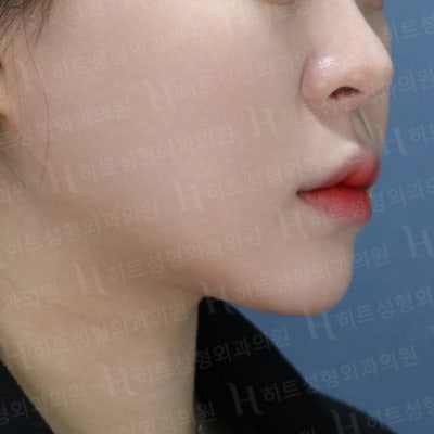 다이어트를 해도 안 빠지는 얼굴살? [히트성형외과] 사진 5