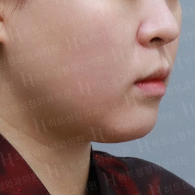 다이어트를 해도 안 빠지는 얼굴살? [히트성형외과] 사진 2