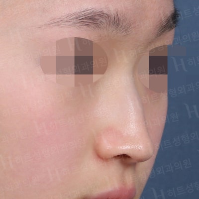 튀어나온 매부리코, 매끈한 콧대로 개선 [히트성형외과 코성형] 사진 2