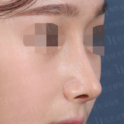 튀어나온 매부리코, 매끈한 콧대로 개선 [히트성형외과 코성형] 사진 5