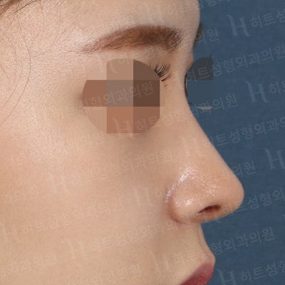 낮은코, 입체감있는 코라인으로 변신 [히트성형외과 코성형] 사진 6