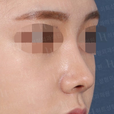 낮은코, 입체감있는 코라인으로 변신 [히트성형외과 코성형] 사진 5