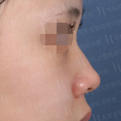 낮은코, 입체감있는 코라인으로 변신 [히트성형외과 코성형] 사진 3