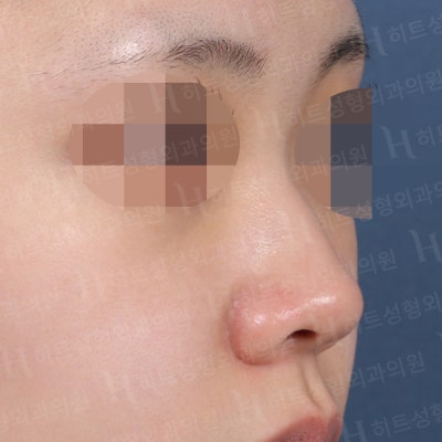 낮은코, 입체감있는 코라인으로 변신 [히트성형외과 코성형] 사진 2