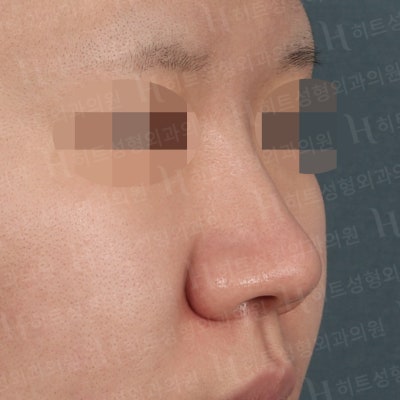 낮고,퍼진 코 날렵한 라인으로 개선[히트성형외과 코성형]