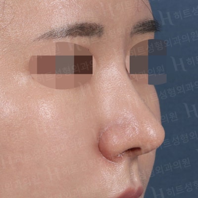 낮고,퍼진 코 날렵한 라인으로 개선[히트성형외과 코성형] 사진 6