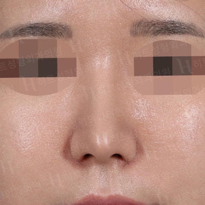 낮고,퍼진 코 날렵한 라인으로 개선[히트성형외과 코성형] 사진 5