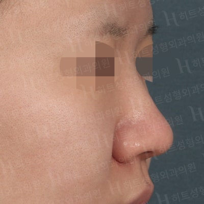 낮고,퍼진 코 날렵한 라인으로 개선[히트성형외과 코성형] 사진 3