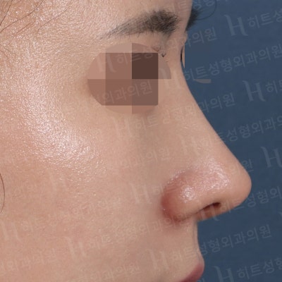 낮고,퍼진 코 날렵한 라인으로 개선[히트성형외과 코성형] 사진 4