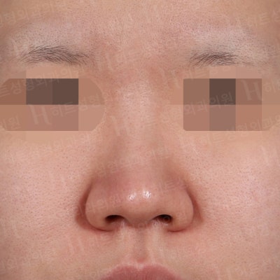 낮고,퍼진 코 날렵한 라인으로 개선[히트성형외과 코성형] 사진 2