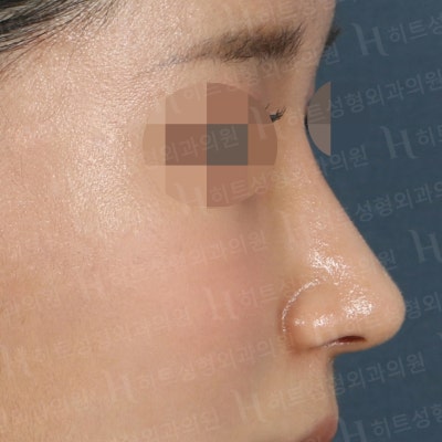 매부리코, 펑퍼짐한 복코 매끄러운 라인으로 [히트성형외과] 사진 4