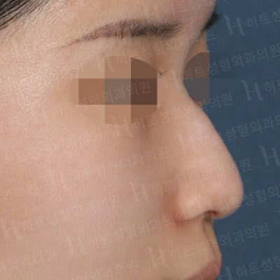 매부리코, 펑퍼짐한 복코 매끄러운 라인으로 [히트성형외과]
