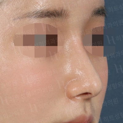 매부리코, 펑퍼짐한 복코 매끄러운 라인으로 [히트성형외과] 사진 5