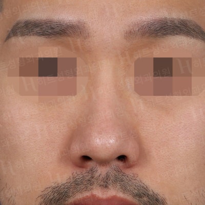 남자코성형 매부리,복코 매끈하게 개선하기 위해서는 [히트성형외과]