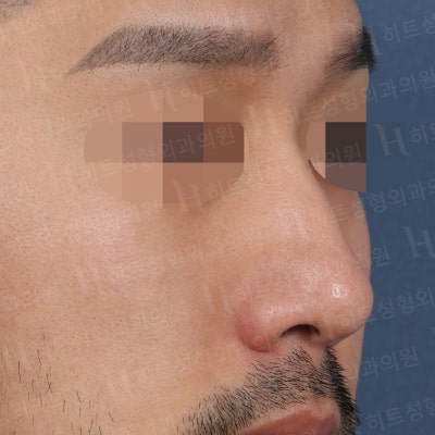 남자코성형 매부리,복코 매끈하게 개선하기 위해서는 [히트성형외과] 사진 2