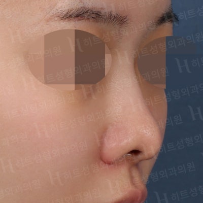 흰코, 코재수술 본인에게 맞는 수술방법으로! [히트성형외과] 사진 3