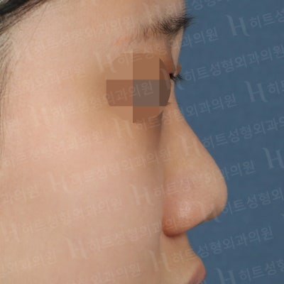 복코성형, 뭉툭하고 퍼져보이는 코라면?[히트성형외과] 사진 5