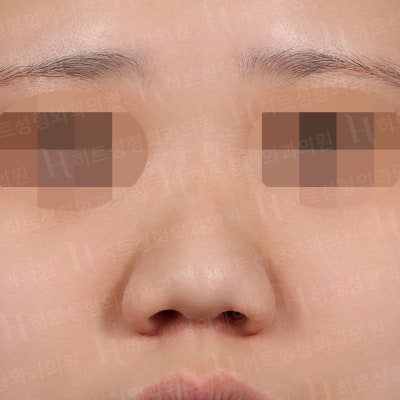 복코성형, 뭉툭하고 퍼져보이는 코라면?[히트성형외과]