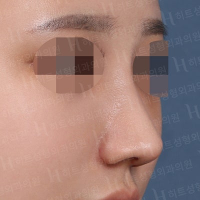 복코성형, 뭉툭하고 퍼져보이는 코라면?[히트성형외과] 사진 4