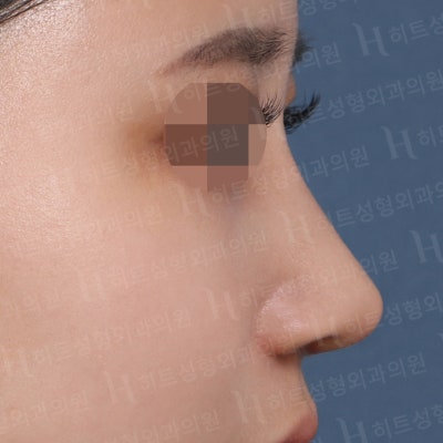 복코성형, 뭉툭하고 퍼져보이는 코라면?[히트성형외과] 사진 6