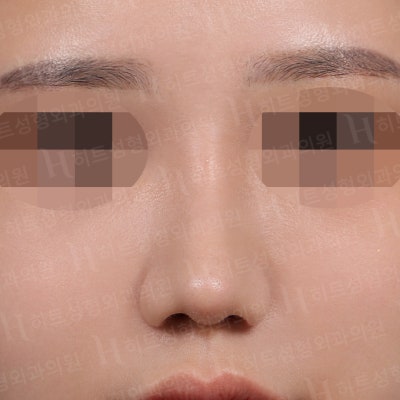 복코성형, 뭉툭하고 퍼져보이는 코라면?[히트성형외과] 사진 2