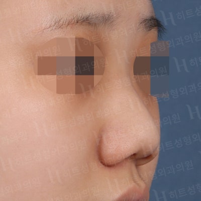 복코성형, 뭉툭하고 퍼져보이는 코라면?[히트성형외과] 사진 3