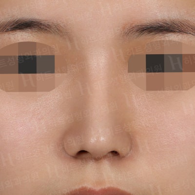 복코,매부리코 나에게 딱 맞는 성형은? [히트성형외과] 사진 2
