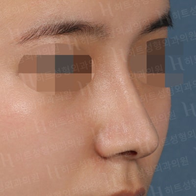 복코,매부리코 나에게 딱 맞는 성형은? [히트성형외과] 사진 4