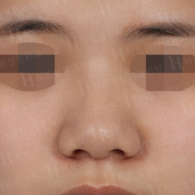 복코,매부리코 나에게 딱 맞는 성형은? [히트성형외과]