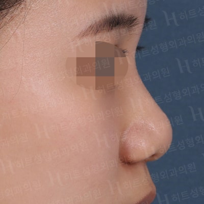 복코,매부리코 나에게 딱 맞는 성형은? [히트성형외과] 사진 5