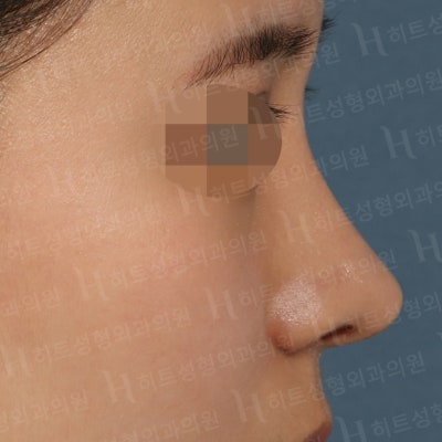복코,매부리코 나에게 딱 맞는 성형은? [히트성형외과] 사진 6