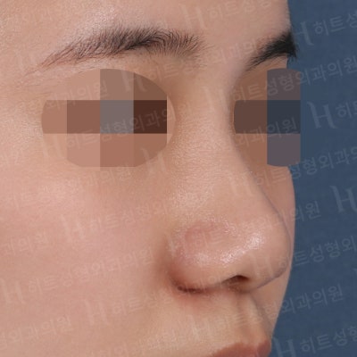 복코,매부리코 나에게 딱 맞는 성형은? [히트성형외과] 사진 3