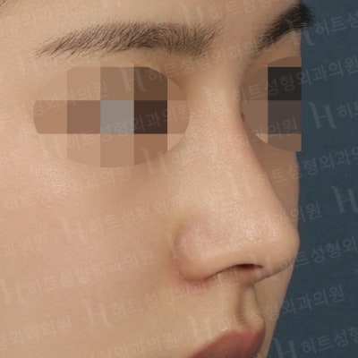 복코교정,매부리교정 세련된 코 라인을 [히트성형외과 - 박정열원장님] 사진 4