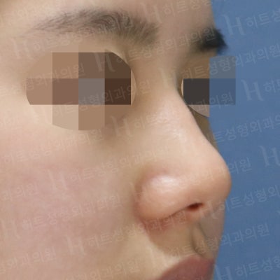 복코교정,매부리교정 세련된 코 라인을 [히트성형외과 - 박정열원장님]