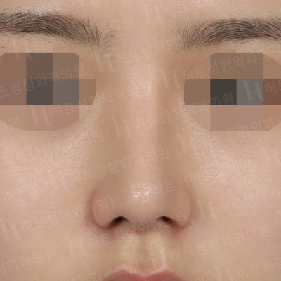 복코교정,매부리교정 세련된 코 라인을 [히트성형외과 - 박정열원장님] 사진 2