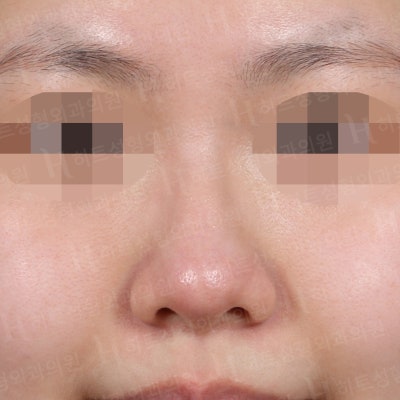 매부리코,비순각,복코교정 나에게 맞는 수술플랜으로! [히트성형외과-한상철원장님]