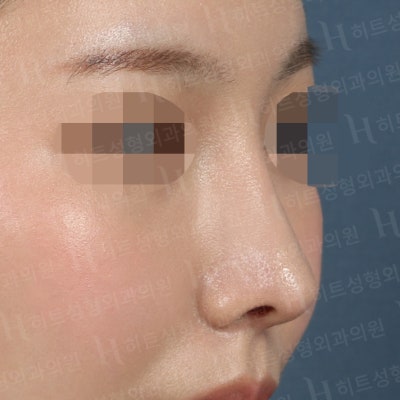 매부리코,비순각,복코교정 나에게 맞는 수술플랜으로! [히트성형외과-한상철원장님] 사진 4